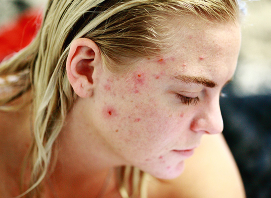 Acne_20084099_[1]